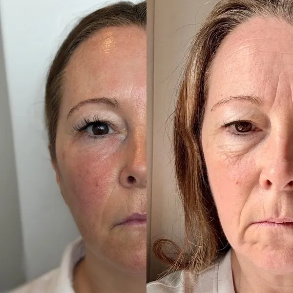 Cortisol Screening ( Stress Hormone ) Test in Beaconsfield